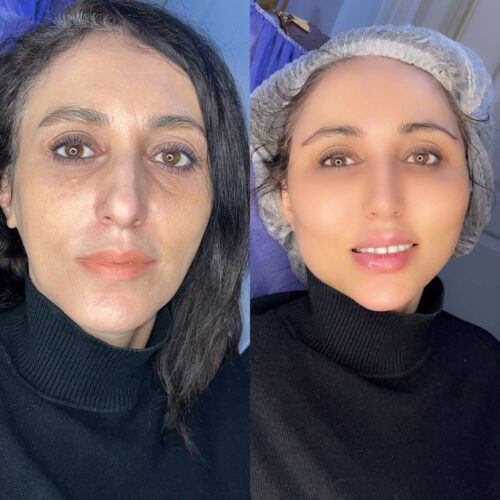 قبل و بعد تزریق چربی