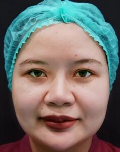 بوکال فت قبل و بعد