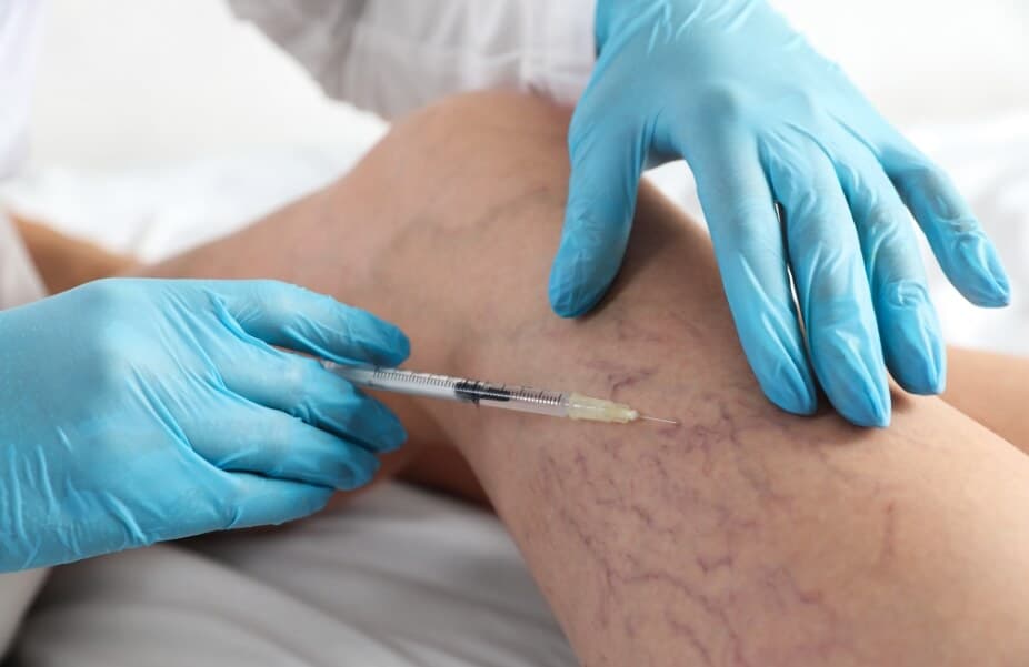 اسکلروتراپی درمان غیرجراجی واریس