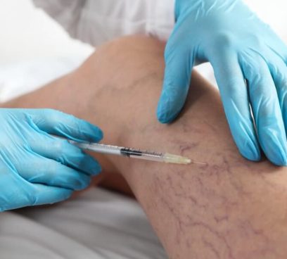 Sclerotherapy-treatment-cost اسکلروتراپی درمان غیرجراجی واریس